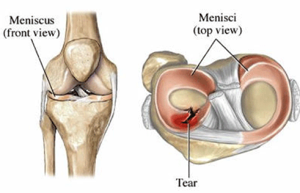 glenferriessc knee menisci | Glenferrie Sports and Spinal Clinic glenferriessc knee menisci